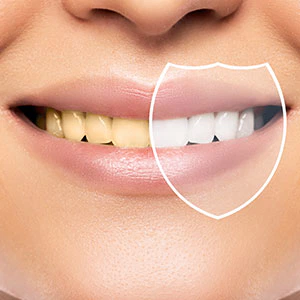 Aclaramiento dental