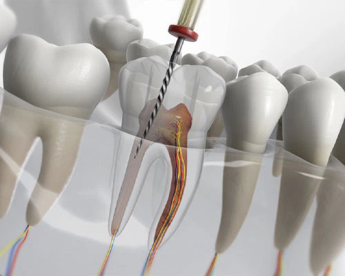 Endodoncia