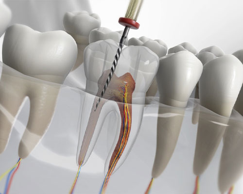 Endodoncia